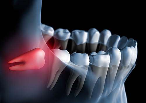 Laser Dentistry in Redlands