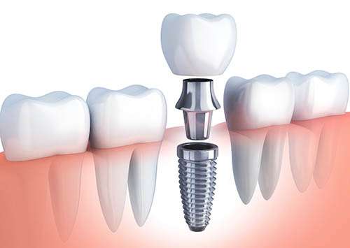 row tooth and Dental implant Laser Dentistry in Redlands, gum surgery
